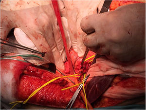 Imagen intraoperatoria de trombectomía con salida de trombo a través de arteria esplénica.
