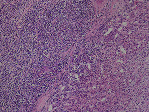 Tumoración compuesta por células monomórficas similares a blastos, con núcleos ovales de localización central y citoplasma basófilo (IgG+). (Hematoxilina y eosina).