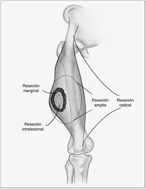 Tipos de resección en sarcomas de partes blandas.