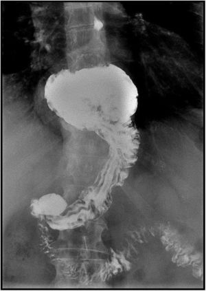 Tránsito baritado que evidencia la hernia de hiato.