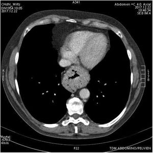 TC toracoabdominal donde se observa la hernia de hiato.