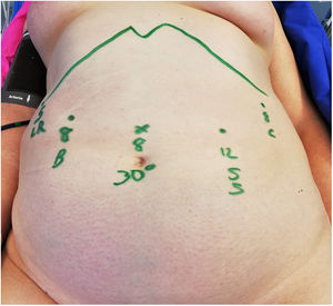 Esquema de distribución de trocares. B: pinza bipolar; C: pinzas; LR: retractor hepático; SS: tijeras y grapadora; 30°: cámara de 30°.