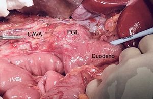Imagen intraoperatoria. Tras movilizar el duodeno medialmente, se evidencia paraganglioma (PGL), masa inferior a la vena renal izquierda, en íntimo contacto con la aorta y vena cava inferior (punta de la pinza).