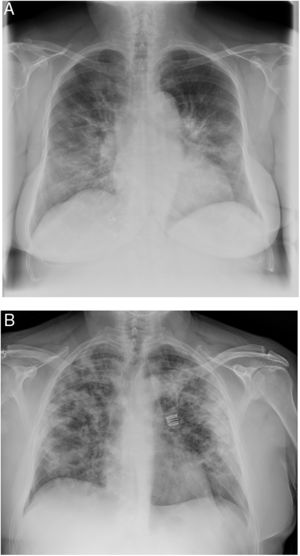 Ejemplos de radiología de tórax simple de pacientes con neumonía en contexto de COVID-19. A. Neumonía moderada, con consolidaciones retículo-alveolares en campos medios e inferiores bilaterales. B. Neumonía grave, afectación extensa bilateral con opacidades alveolares, con tendencia la consolidación en la periferia de ambos campos pulmonares.