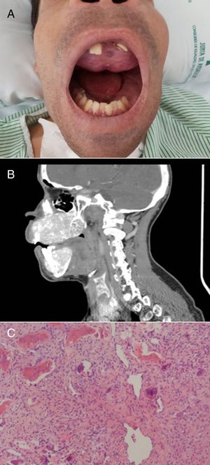A) Deformidad del maxilar y la mandíbula. Tumor pardo en el paladar superior. B) TAC del cráneo que muestra una enfermedad ósea difusa caracterizada por la deformidad obvia de la mandíbula superior e inferior, desmineralización del esqueleto axial y lesiones extensas de apariencia lítica. C) Células gigantes mesenquimales y multinucleadas, típicas del tumor pardo (H&E, ×50).