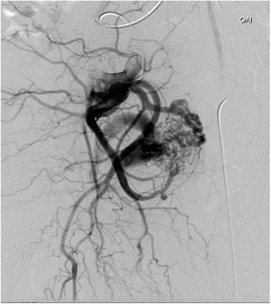 Imagen arteriográfica de la MAV: aporte arterial de las arterias vesicales y drenaje venoso por venas pudendas que presentan 2 estenosis.