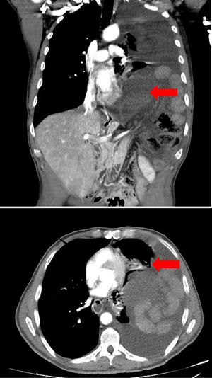 Proyección coronal de la TC donde se objetiva colon isquémico y su relación con el músculo cardíaco. Proyección axial de la TC donde se objetiva atelectasia pulmonar izquierda y compresión cardíaca (ambos marcados con flecha).