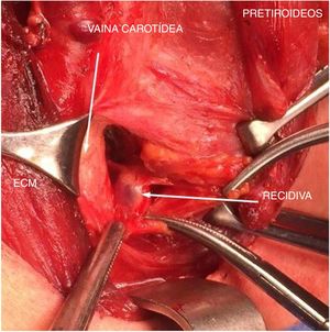 Localización intraoperatoria del nódulo y la semilla. ECM: músculo esternocleidomastoideo.