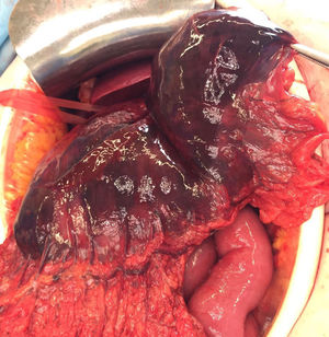 Isquemia gástrica masiva con edema y necrosis.