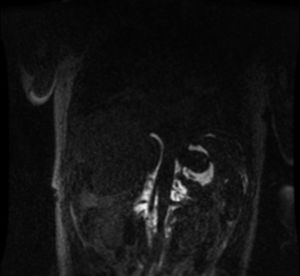 Linfangiografía en fase precoz que muestra una masa abdominal de 7cm que se extiende desde los vasos celíacos hasta los hilios renales rodeando la aorta abdominal.