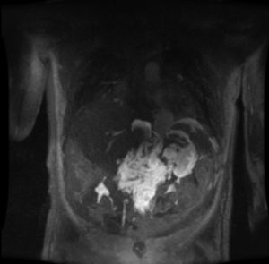 Linfangiografía en fase tardía que muestra extravasación del medio de contraste hacia la cavidad abdominal.