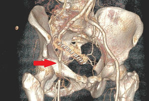 Reconstrucción 3D en la que se observa la estenosis a nivel de la transición iliofemoral derecha.