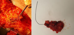 Biopsia del ganglio clipado marcado con arpón colocado de manera ecoguiada. A la izquierda, se muestra la disección del ganglio dirigido por arpón a través de una incisión de mastectomía. A la derecha, la pieza quirúrgica extraída y enviada a anatomía patológica para su análisis intraoperatorio mediante One-Step Nucleic Acid Amplification (OSNA).