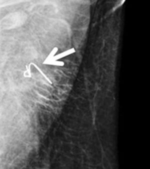 Mamografía tras la implantación de arpón ecoguiado. El arpón se observa en la adenopatía marcada con clip (flecha).
