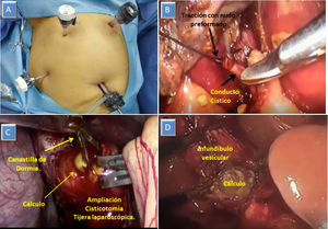 A. colocación de puerto a la izquierda. B. Ligadura de conducto cístico y nueva cisticotomía. C. Ampliación de cisticotomía sobre cálculo. D. Apertura vesicular y extracción de cálculo clavado en el infundíbulo.