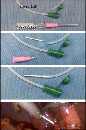 Reducción de diámetro de catéter de colangiografía. Se introduce el material plástico recortado de un catéter sobre aguja 20 en una sonda k35.
