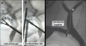 A. Cístico desfavorable (tortuoso). B. Disección proximal de conducto cístico. C. Cisticotomía angulada. ITC: instrumentación transcística.