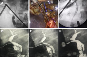 A. Dilatación papilar anterógrada progresiva y controlada con balón percutáneo. B y C. Cuerda y canastilla en tándem. D-F. Secuencia de extracción de tubo en T con alambre guía.