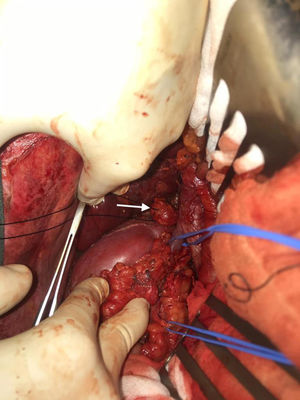 Imagen macroscópica del campo quirúrgico: se visualiza implante de 2,5cm en espacio retrocavo a nivel de vena renal derecha.