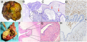 Caso 2. A) Pieza de hepatectomía que incluye la lesión quística. B) Dicha lesión presenta un revestimiento epitelial mucinoso y algunas áreas con proliferación intraluminal (40x, hematoxilina eosina). C) Presencia de zonas con displasia de alto grado en superficie y carcinoma invasivo (flechas) (200x, hematoxilina eosina). D) Inmunohistoquímica positiva para marcadores de estroma mülleriano.Caso 3. E) Imagen macroscópica de pieza de resección hepática atípica. F) El estudio histológico muestra la presencia de un quiste revestido de epitelio simple (40x, hematoxilina eosina). G) Bajo el epitelio se observa un denso estroma celular subyacente característico de las neoplasias quísticas mucinosas (400x, hematoxilina eosina). H) Imagen de tinción inmunohistoquímica que muestra células estromales con núcleos positivos para anticuerpos antirreceptores de progesterona y estrógenos con tinción nuclear positiva.