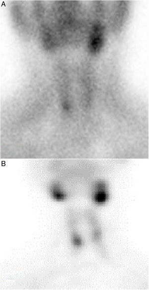 Gammagrafía de localización preoperatoria para la primera cirugía A) y antes de la reintervención B).