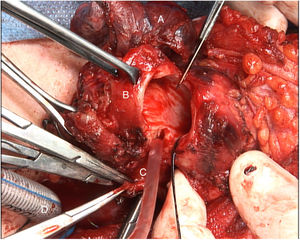 Resección de tráquea en bloque junto con esófago cervical y lóbulo tiroideo derecho. A: lóbulo tiroideo derecho; B: anillos traqueales seccionados; C: sección esofágica con mucosa expuesta; D: intubación endotraqueal a través del extremo distal traqueal seccionado.