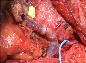 Anastomosis microvascular termino-terminal mecánica circular entre vena yeyunal (A) y tronco venoso tirolinguofacial (B).