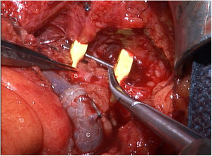 Anastomosis arterial termino-terminal manual mediante puntos simples entre la arteria mamaria interna (A) y la arteria yeyunal (B). C: anastomosis venosa termino-terminal; D: meso yeyunal.