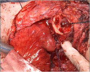 Reconstrucción del tracto digestivo mediante injerto de yeyuno libre con anastomosis hipofaringe-yeyunal termino-lateral manual (A). Se aprecia la tráquea seccionada en su extremo craneal (B).