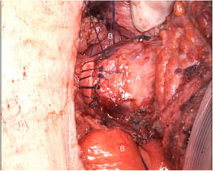 Anastomosis traqueal termino-terminal manual con puntos simples de Vicryl)3/0 (A). En el plano posterior se aprecia el injerto de yeyuno libre (B).