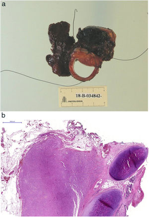 A)Pieza quirúrgica constituida por tráquea, esófago y lóbulo tiroideo derecho. B)Imagen panorámica microscópica en la que se identifica el tumor en relación con el cartílago traqueal. C)Imagen de microscopia óptica en la que se aprecia que el tumor infiltra la pared traqueal con extensa afectación de la submucosa.