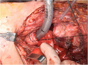 Aproximación de los extremos traqueales seccionados para su posterior anastomosis (A). En el plano posterior se aprecia el injerto de yeyuno libre (B).