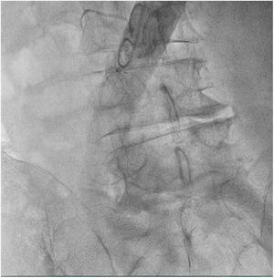 Intento de captura con lazo y guía vía femoral derecha.