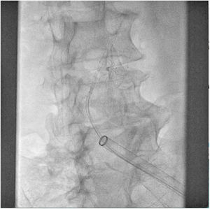 Intento de captura vía femoral izquierda.