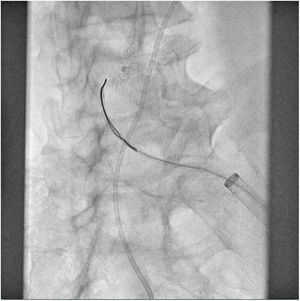 Intento de captura vía femoral izquierda.