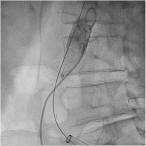 Disección de aorta abdominal y de arteria ilíaca común derecha.