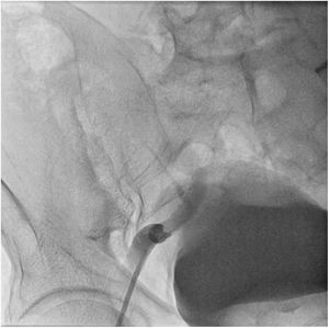 Disección de aorta abdominal y de arteria ilíaca común derecha.
