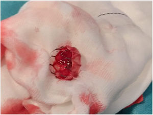 Arteriotomía con extracción de dispositivo y cierre del defecto con corrección de la disección con parche de pericardio bovino.