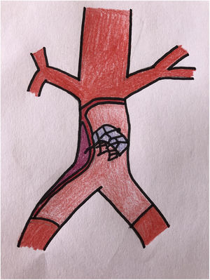 Arteriotomía con extracción de dispositivo y cierre del defecto con corrección de la disección con parche de pericardio bovino.