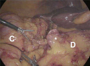 Divertículo duodenal. Se observa el divertículo (*) en cara anterior de segunda porción duodenal durante la colectomía derecha. D: duodeno; C: colon.
