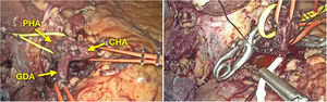 Disección de arteria gastroduodenal (AGD), arteria hepática común (CHA) y arteria hepática propia (PHA). Inserción de catéter intraarterial en AGD.