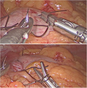 Anudado intracopóreo mediante FlexDex®.