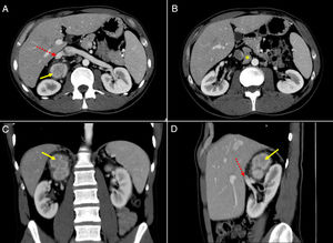 CT scan (a–b, Axial view; c, Coronal view; d, Sagittal view), showing a heterogeneous mass in the right adrenal gland topography, with intense contrast enhancement (yellow arrow) and close to the right renal vein in its origin from inferior vena cava (discontinuous red arrow). In a lower axial view, an irregular adenopathy was found in the retroperitoneum (yellow asterisk), between the aorta and vena cava, next to the lower margin of the tumor.