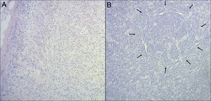 Microscopic findings of the resected mass, with hematoxylin and eosin staining (magnification ×100): (A) Normal adrenal gland tissue. (B) Normal spleen tissue: small lymphocytes are observed in a concentric arrangement around arterioles (black arrows).