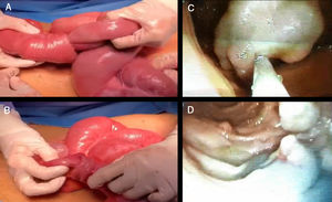(A and B) Invaginated intestinal segments with dilation of the proximal segments. (C) Polypectomy with mucosectomy technique of the largest polyp by hand-assisted enteroscopy. (D) Mucosa after resection of the polyps.