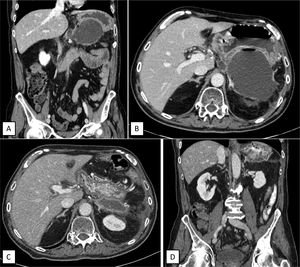 Post-operative scheduled CT scan showing retrogastric collection (A: Coronal view. B: Cross-section showing posterior gastric wall thinning) and control CT scan after completing endoluminal vacuum-assisted therapy, showing decrease in collection size, without defects on the gastric wall (C: Cross-sectional view. D: Coronal view).
