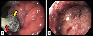 Endoscopic images showing endoluminal vacuum-assisted therapy (EsoSponge®, Braun) replacement. (A) The sponge covering the gastric defect (yellow arrow), in contact with the negative pressure therapy probe (red arrow). (B) Inside the cavity, in which granulation tissue and fibrin detritus are observed.