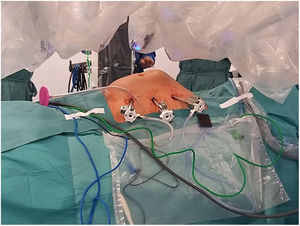 Disposición de los trocares en la línea medioclavicular izquierda.