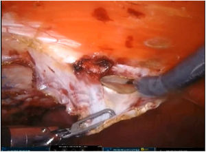 Acceso al espacio preperitoneal posterior a la línea media (crossover).