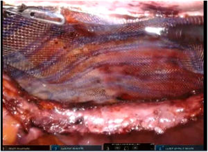 Colocación de la malla.